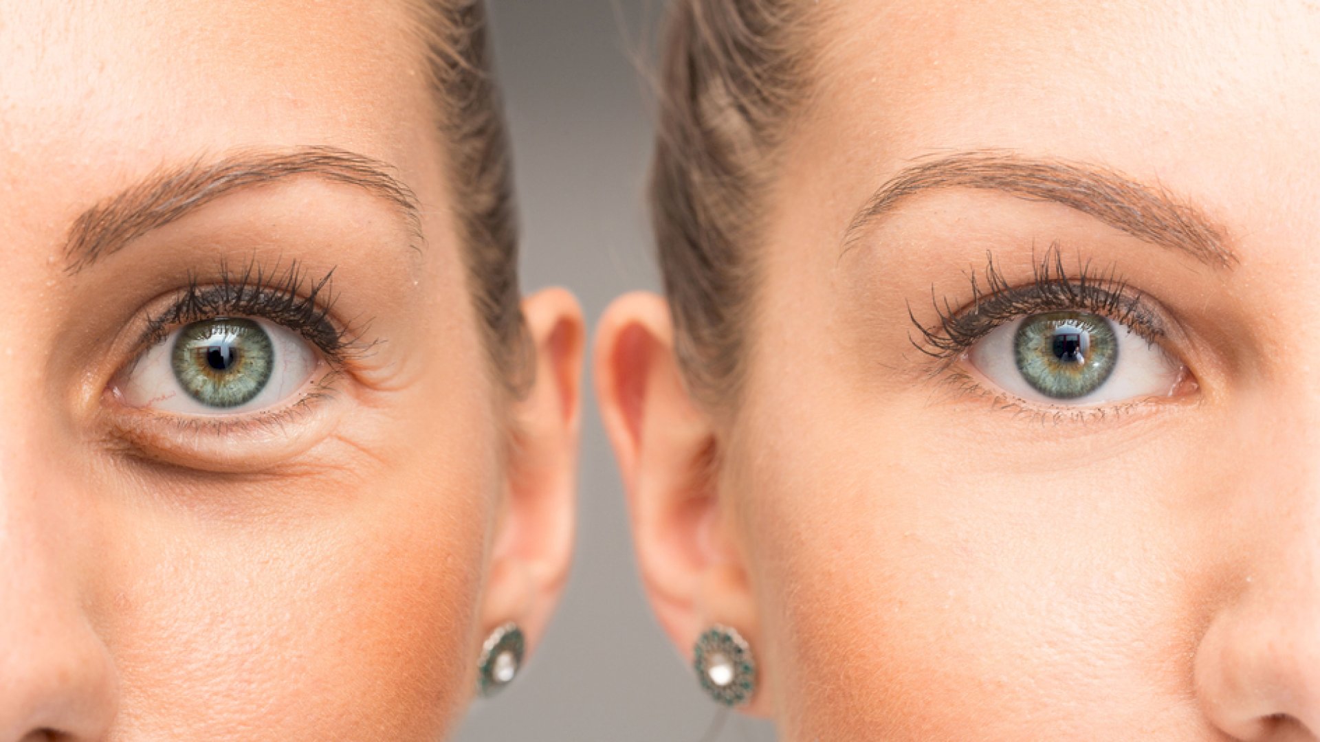 Szem alatti karikák ellen legjobb megoldás